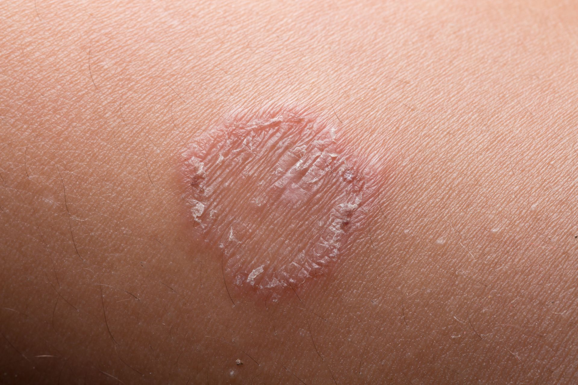 Ringworm on human skin